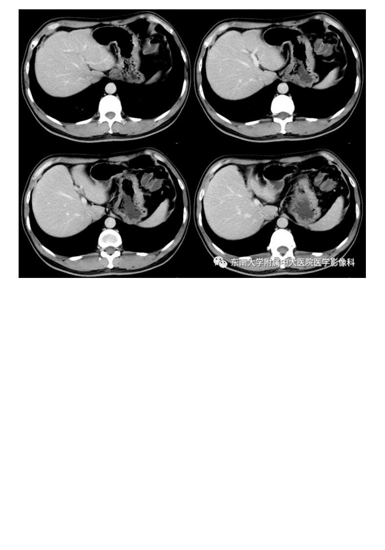 20210113_2【晨读结果公布】2021.01.13消化系统疾病——胃内异位胰腺.pdf 第3页