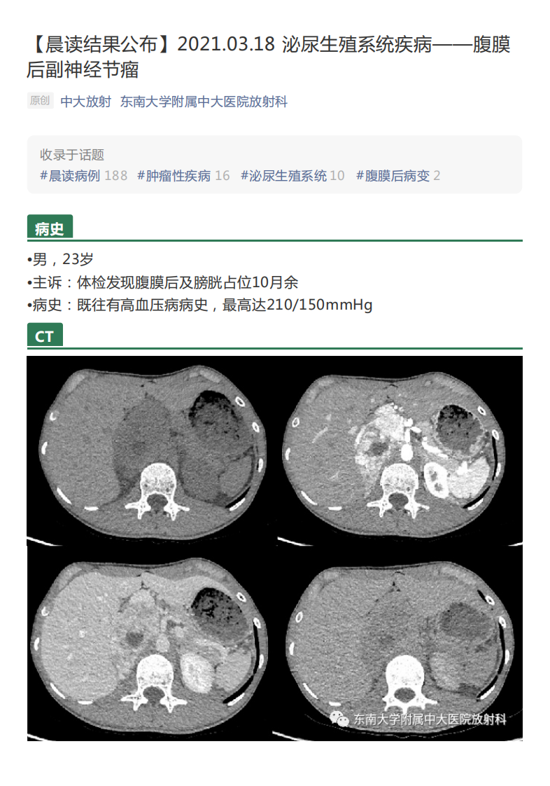 20210319_2【晨读结果公布】2021.03.18泌尿生殖系统疾病——腹膜后副神经节瘤.pdf 第1页