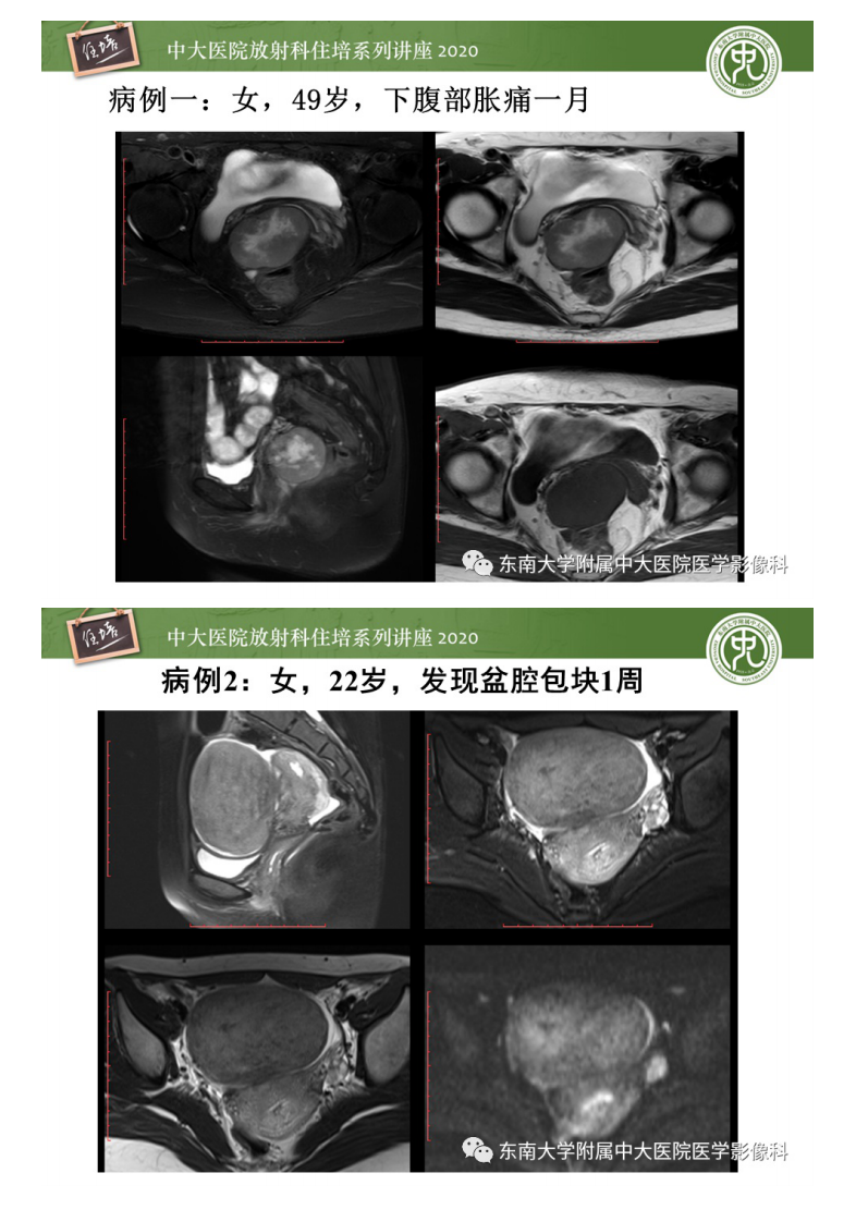 20200413_1【中大放射住培系列讲座】女性盆腔实性占位性病变定位分析.pdf 第2页