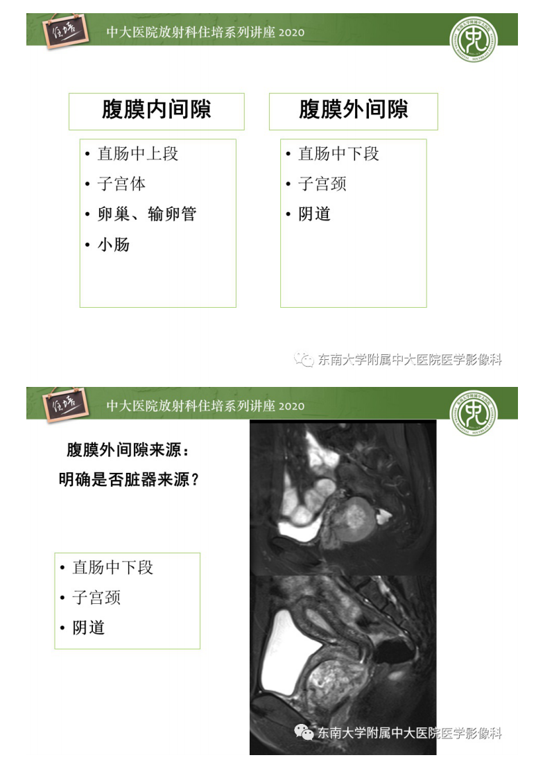 20200413_1【中大放射住培系列讲座】女性盆腔实性占位性病变定位分析.pdf 第4页