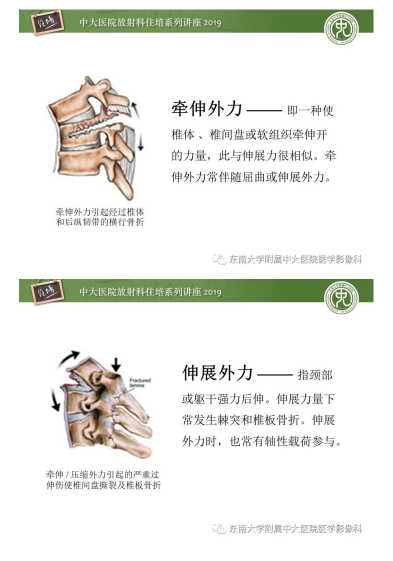 20200309_1【中大放射住培系列讲座】脊柱损伤.pdf 第4页