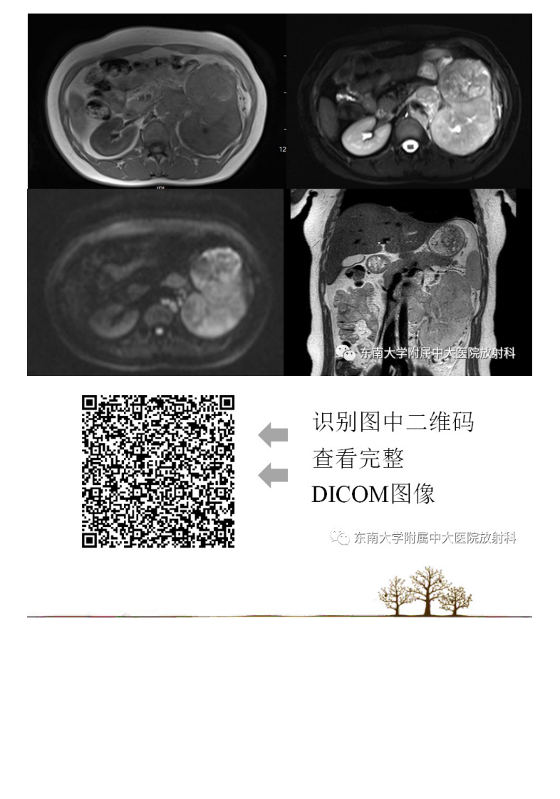 20210622_2【晨读结果公布】2021.06.22泌尿系统疾病——Xp11.2易位TFE3基因融合相关性肾癌.pdf 第3页