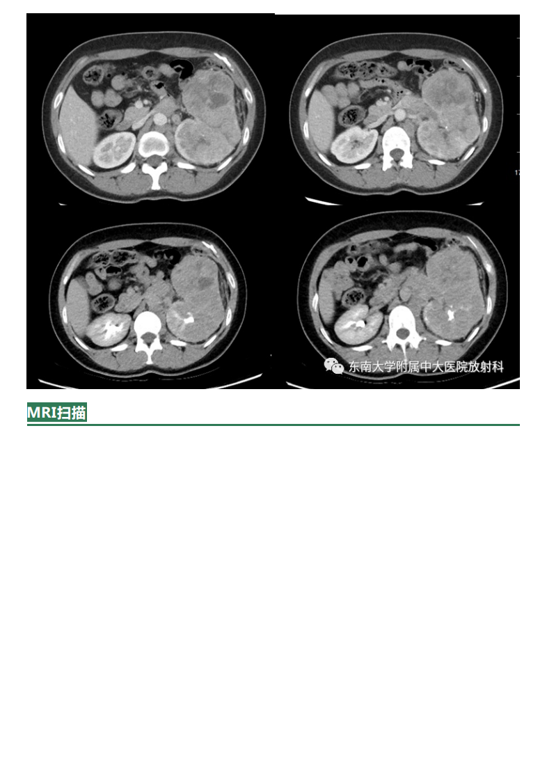 20210622_2【晨读结果公布】2021.06.22泌尿系统疾病——Xp11.2易位TFE3基因融合相关性肾癌.pdf 第2页