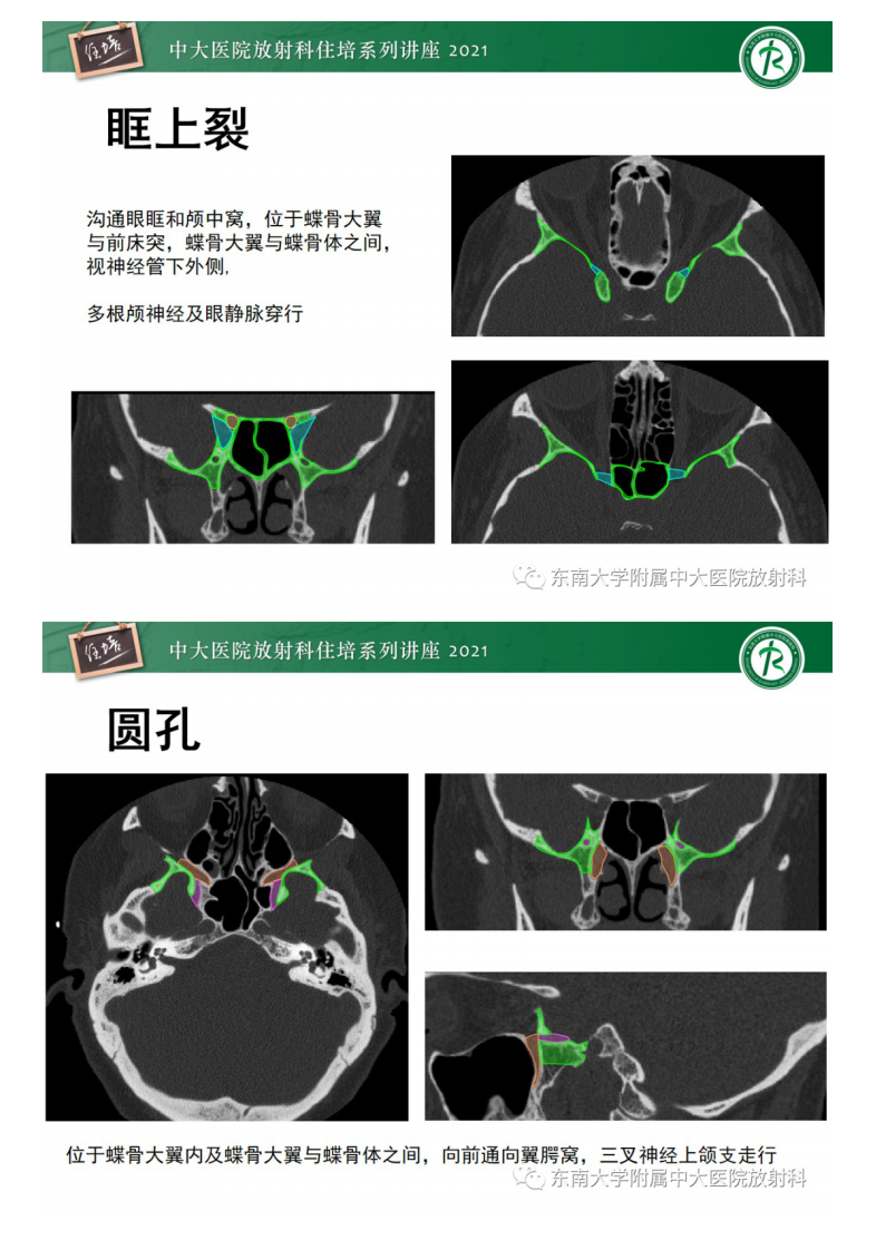 20210328_1【中大放射住培系列讲座】中颅窝底解剖结构及常见骨折征象.pdf 第5页