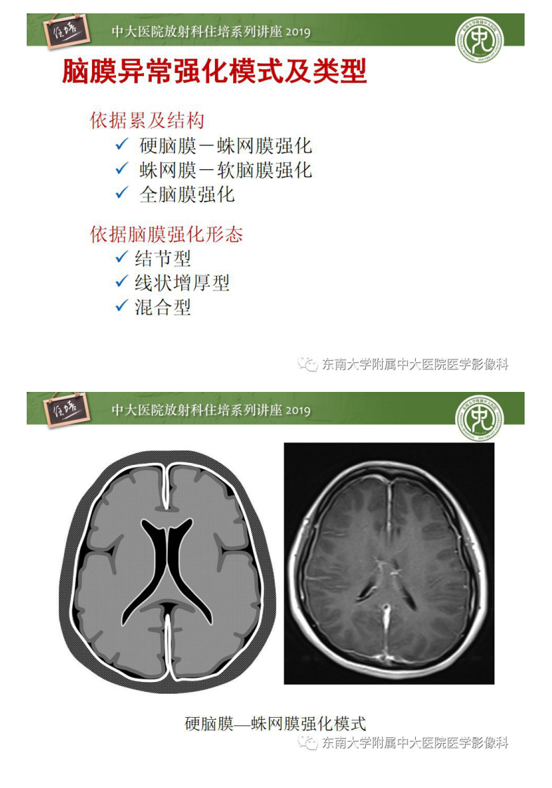 20190707_1【中大放射住培系列讲座第67期】脑膜异常强化及相关病变影像表现.pdf 第5页