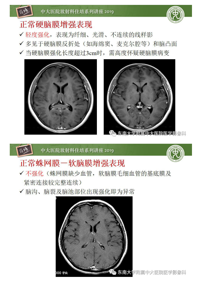 20200224_1【中大放射住培系列讲座】脑膜异常强化及相关病变影像表现.pdf 第4页