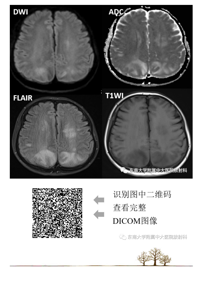 20210415_2【晨读结果公布】2021.04.14神经系统疾病——可逆性后部脑病综合征（PRES）.pdf 第3页