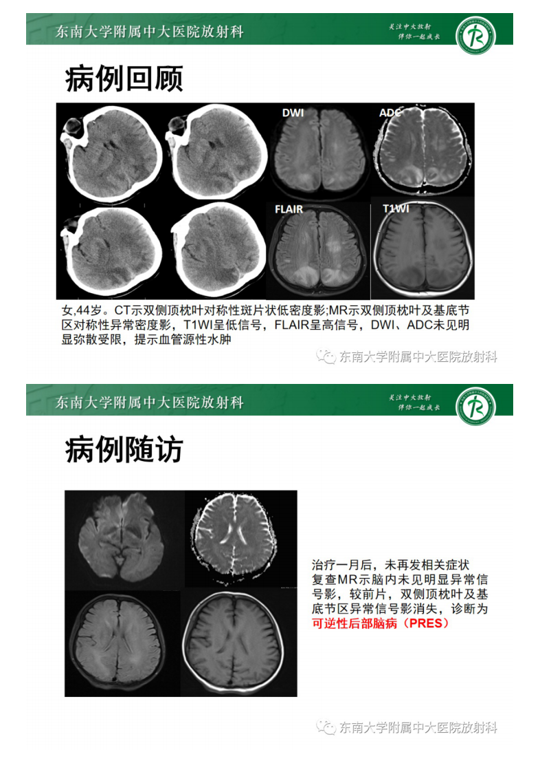 20210415_2【晨读结果公布】2021.04.14神经系统疾病——可逆性后部脑病综合征（PRES）.pdf 第4页