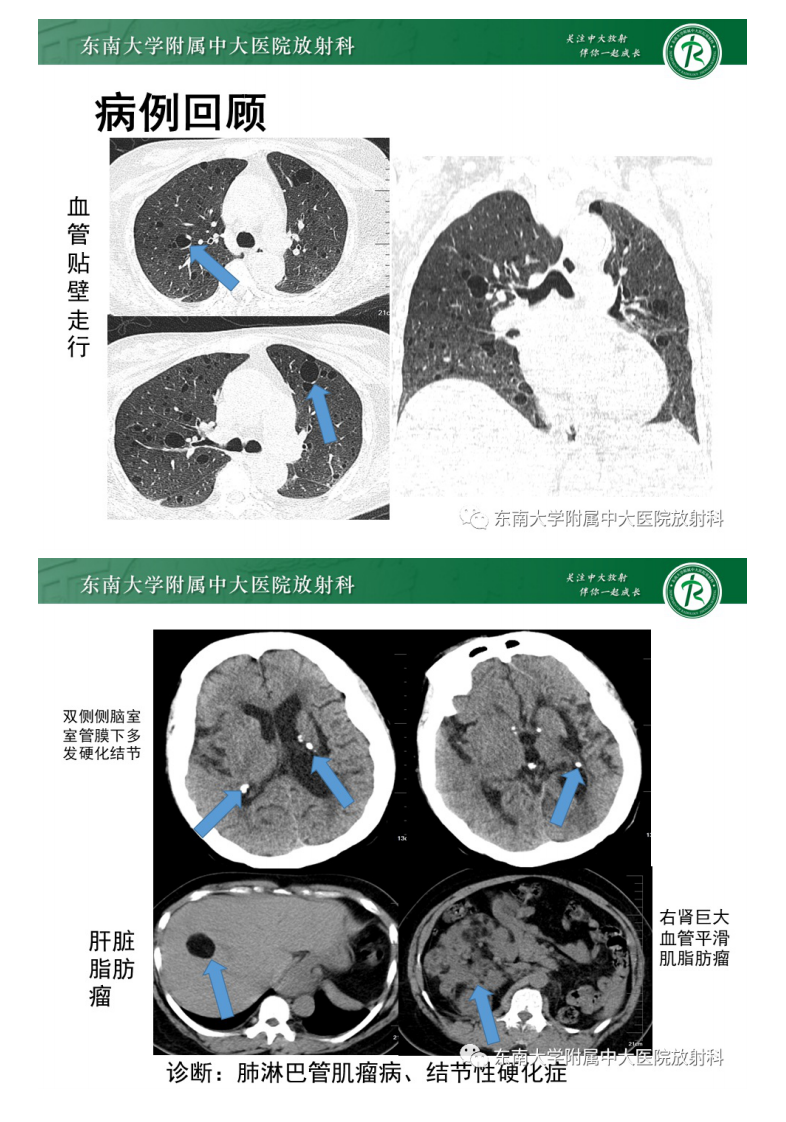 20210219_2【晨读结果公布】2021.02.19呼吸系统疾病——肺淋巴管肌瘤病.pdf 第3页
