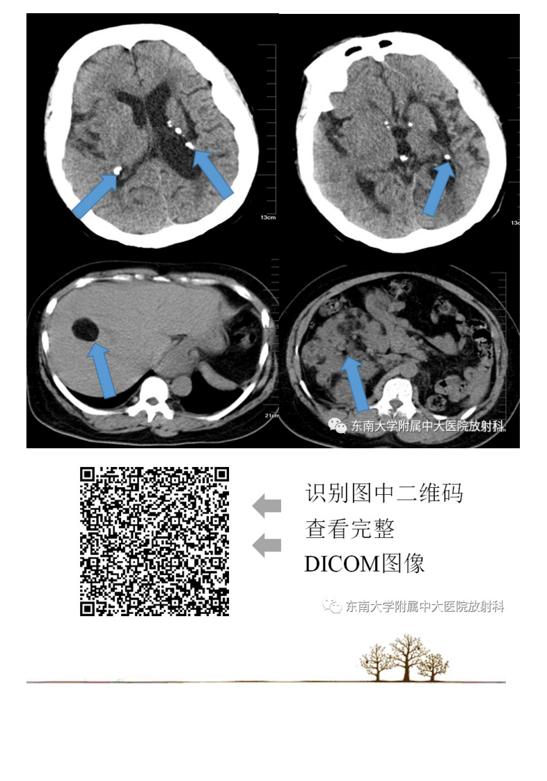 20210219_2【晨读结果公布】2021.02.19呼吸系统疾病——肺淋巴管肌瘤病.pdf 第2页