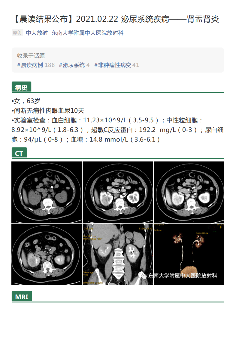 20210222_2【晨读结果公布】2021.02.22泌尿系统疾病——肾盂肾炎.pdf 第1页