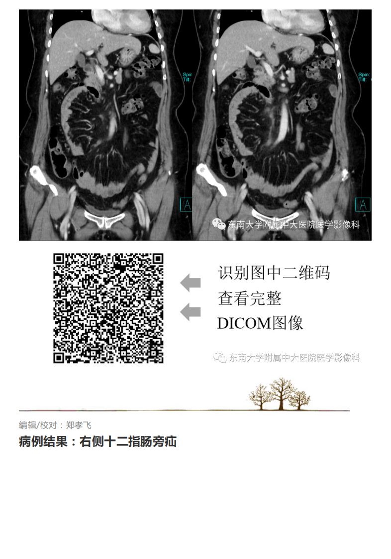 20201014_2【晨读结果公布】2020.10.14消化系统疾病——腹内疝.pdf 第4页