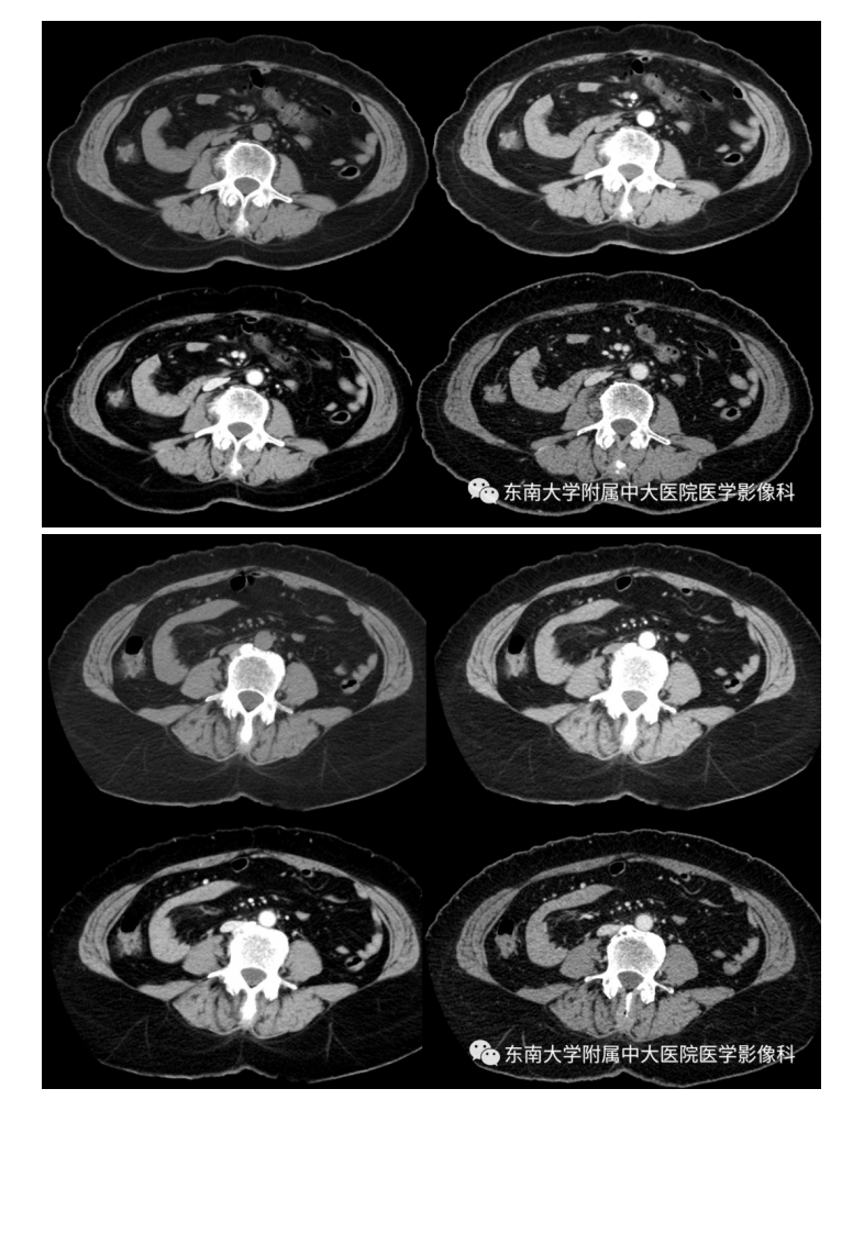 20201014_2【晨读结果公布】2020.10.14消化系统疾病——腹内疝.pdf 第3页