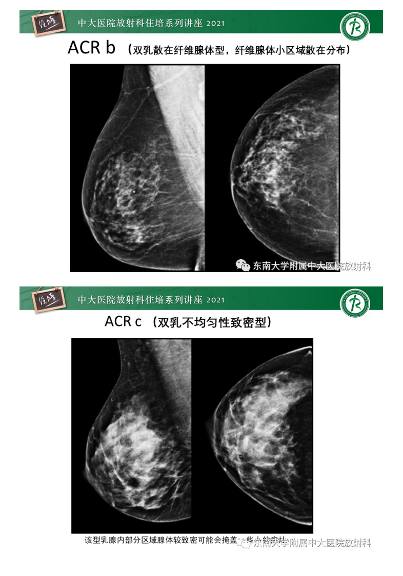 20210228_1【中大放射住培系列讲座】DBT相较于FFDM对于不同X线表现类型乳腺病变的诊断价值.pdf 第5页