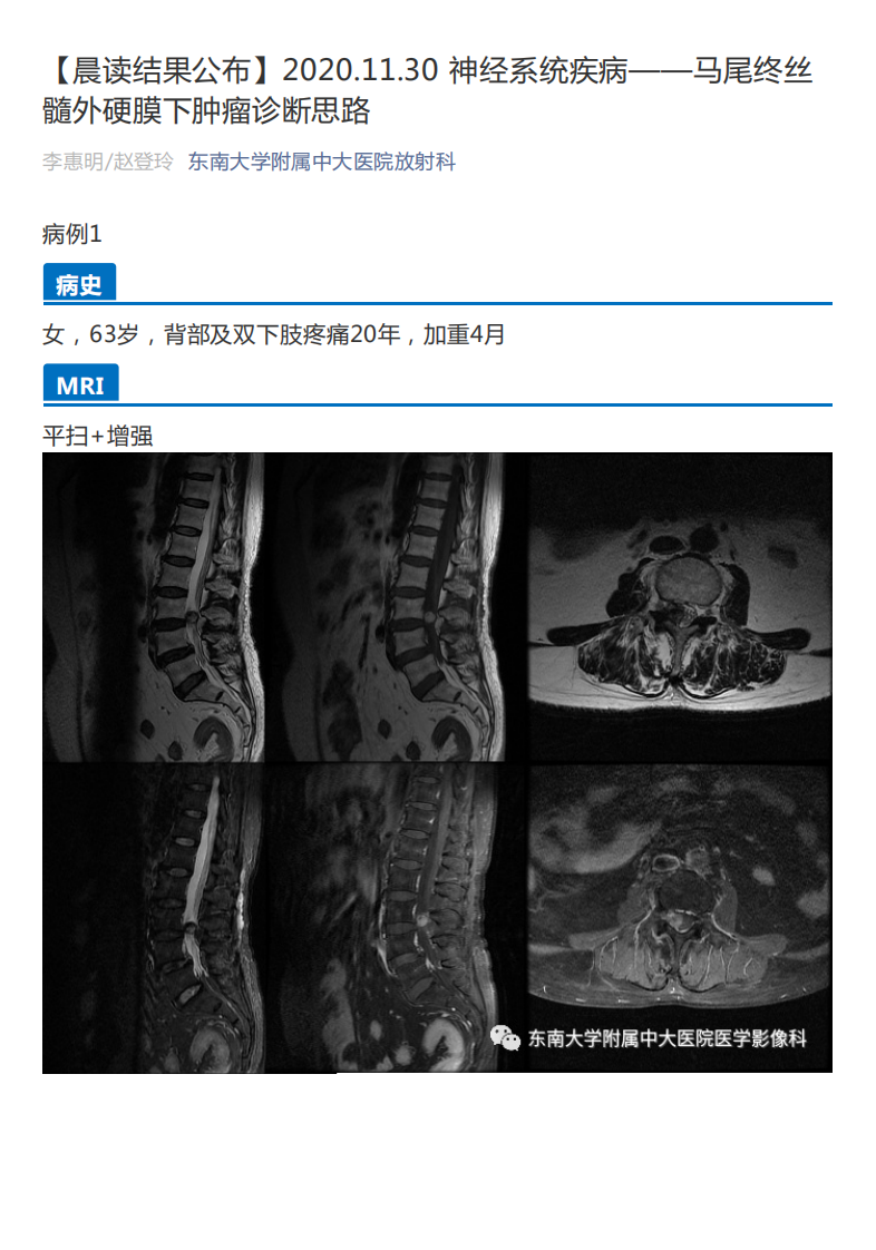 20201130_3【晨读结果公布】2020.11.30神经系统疾病——马尾终丝髓外硬膜下肿瘤诊断思路.pdf 第1页