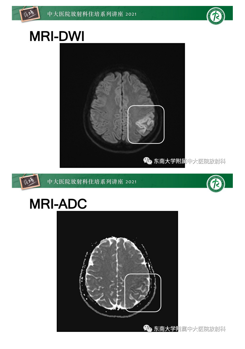 20210506_1【中大放射住培系列讲座】静脉性脑梗死的诊断思路.pdf 第4页