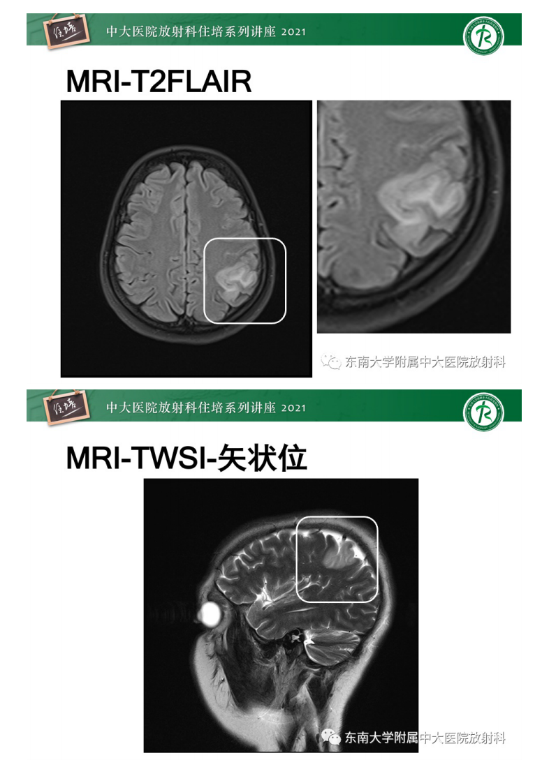20210506_1【中大放射住培系列讲座】静脉性脑梗死的诊断思路.pdf 第5页
