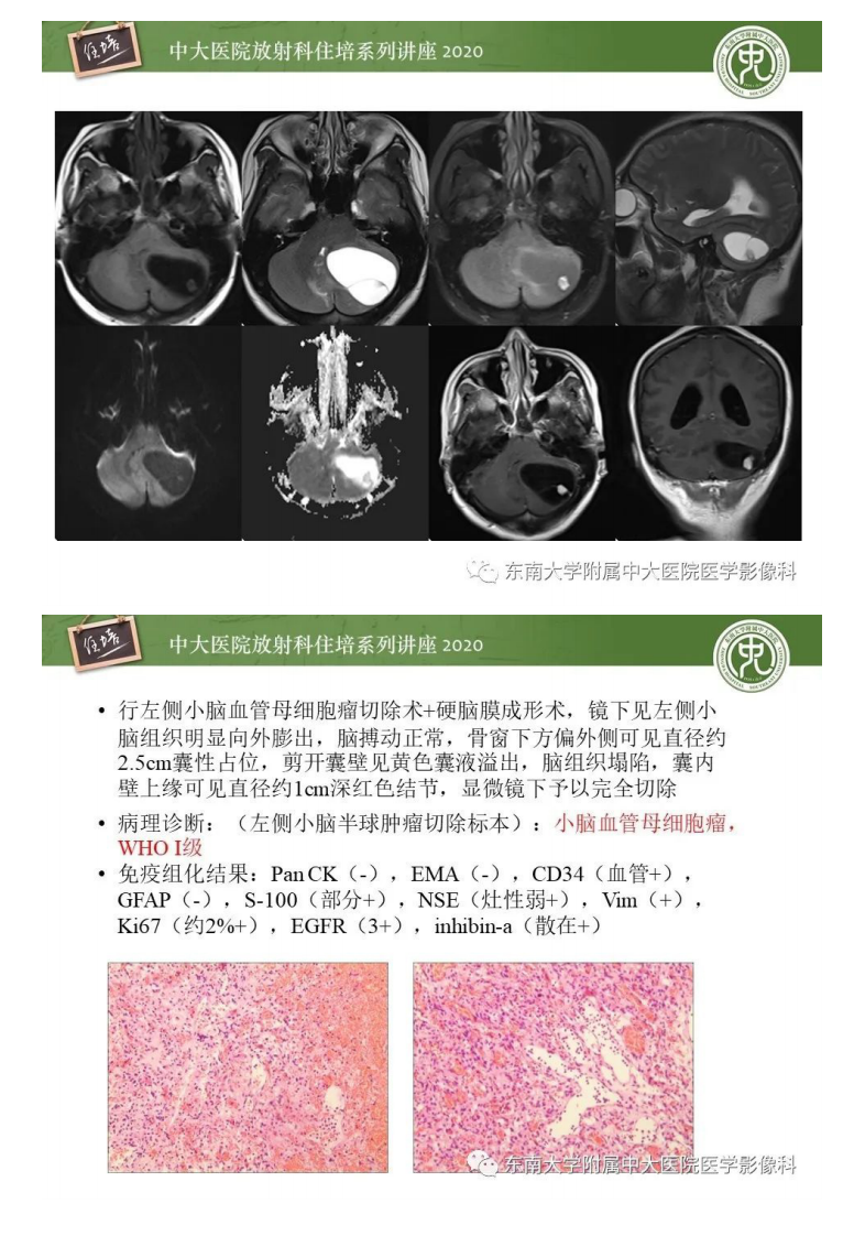 20200510_1【中大放射住培系列讲座】小脑占位的影像分析思路.pdf 第5页