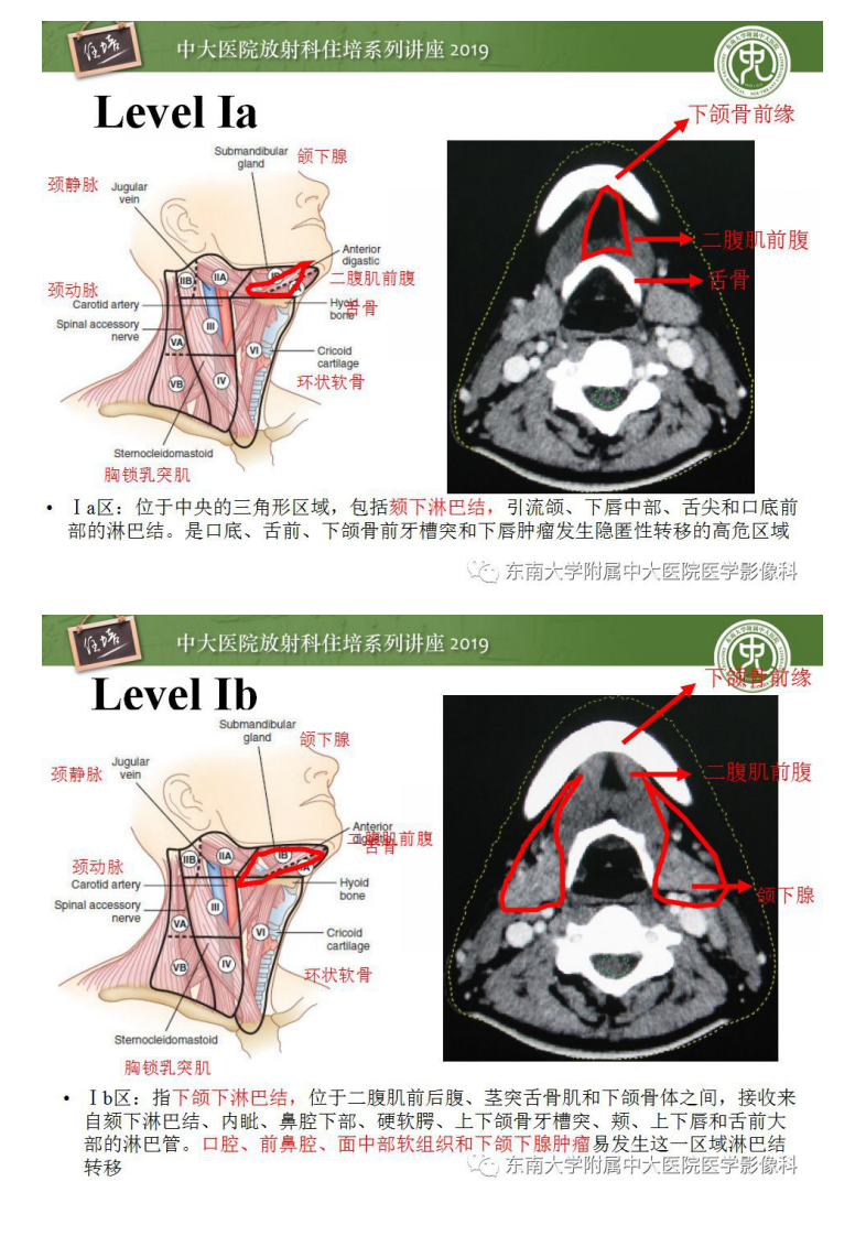 20190115_1【2018住培系列讲座第45期】颈部淋巴结的影像解剖及常见病变的影像表现.pdf 第5页