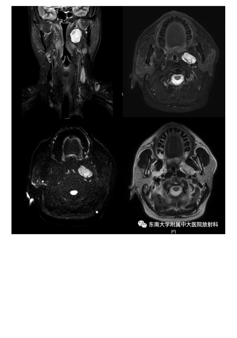 20210617_2【晨读结果公布】2021.06.17头颈部疾病——多形性腺瘤.pdf 第2页