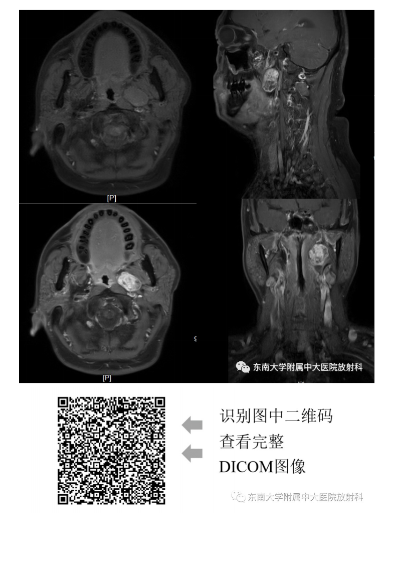 20210617_2【晨读结果公布】2021.06.17头颈部疾病——多形性腺瘤.pdf 第3页