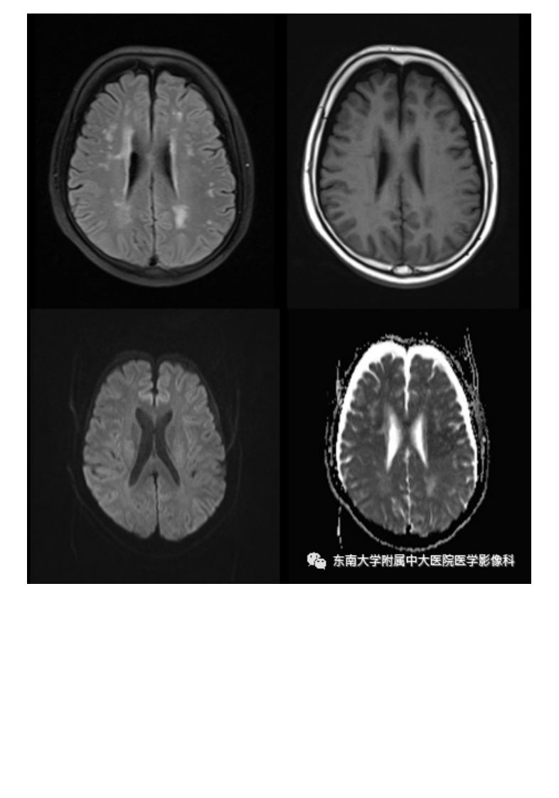 20201216_2【晨读结果公布】2020.12.15神经系统疾病&mdash;&mdash;脑卒中模拟病.pdf 第2页