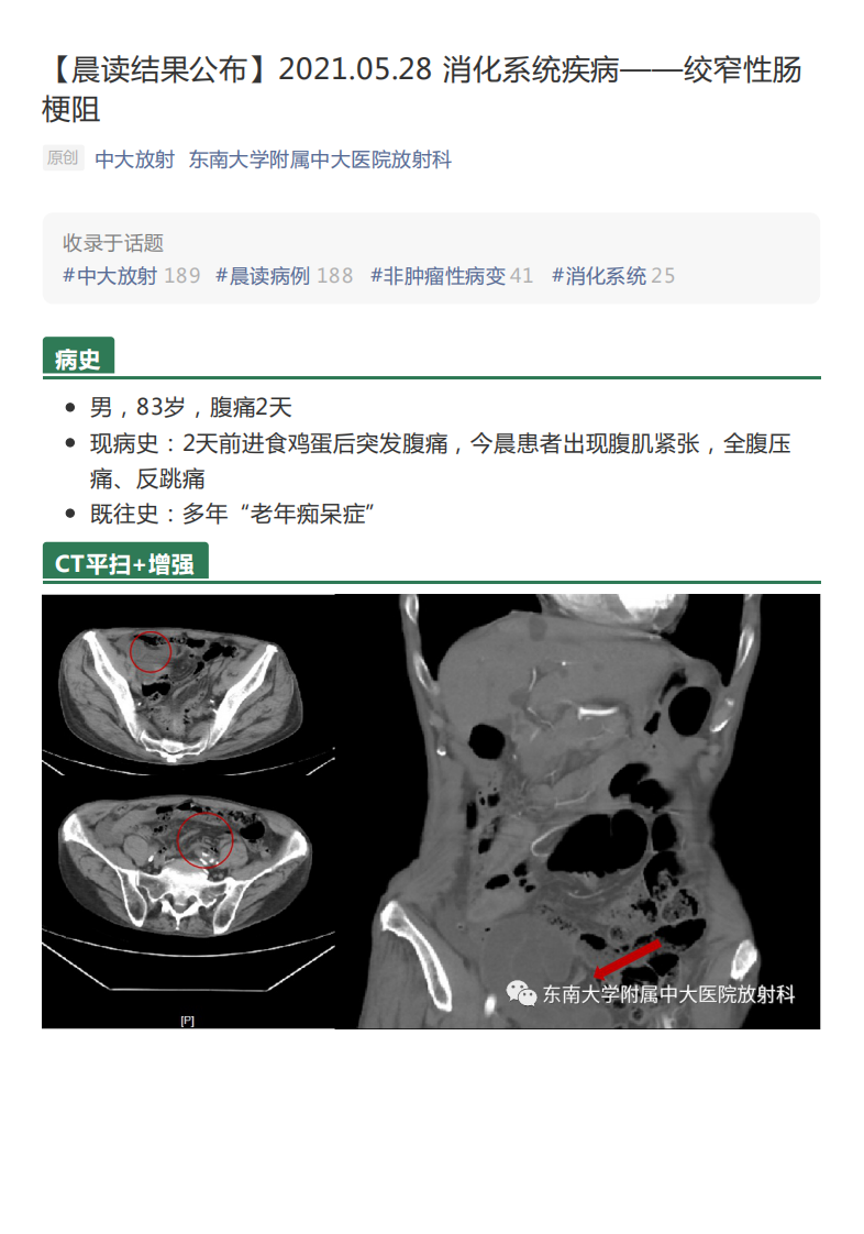 20210530_2【晨读结果公布】2021.05.28消化系统疾病&mdash;&mdash;绞窄性肠梗阻.pdf 第1页