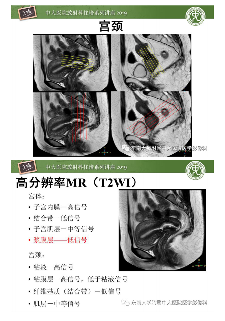 20200204_1【中大放射住培系列讲座】子宫影像解剖及相关MR信号分析.pdf 第4页