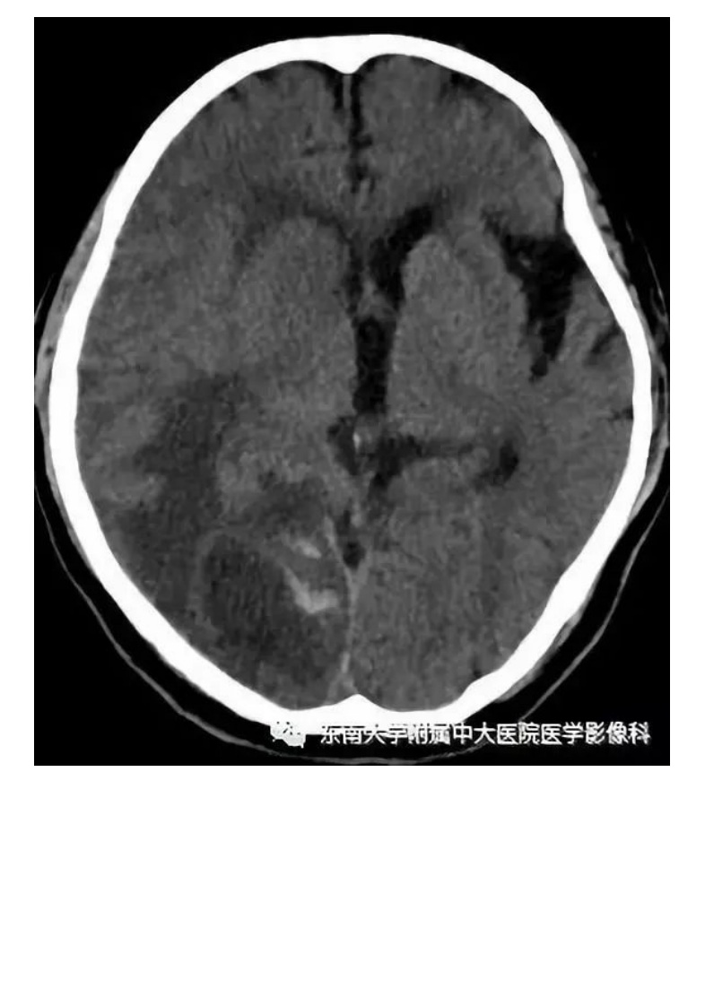 20190909_2【晨读结果公布】2019.09.09神经系统疾病.pdf 第2页