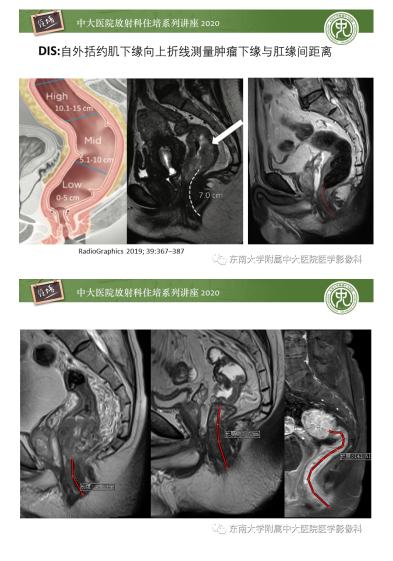 20210103_1【中大放射住培系列讲座】直肠癌影像临床分期注意事项.pdf 第4页