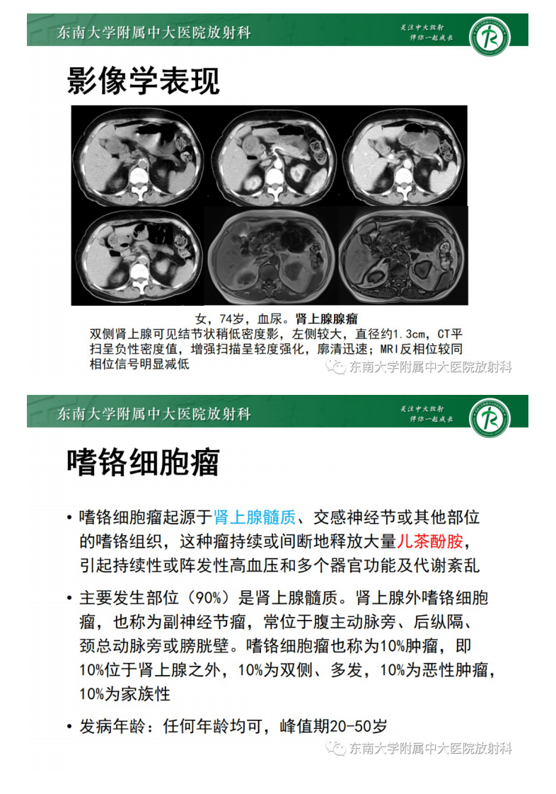 20210413_2【晨读结果公布】2021.04.13泌尿生殖系统疾病——肾上腺嗜铬细胞瘤.pdf 第5页