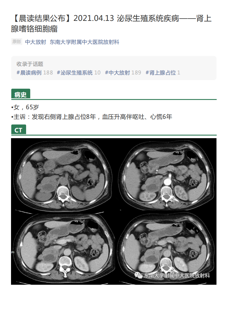 20210413_2【晨读结果公布】2021.04.13泌尿生殖系统疾病——肾上腺嗜铬细胞瘤.pdf 第1页