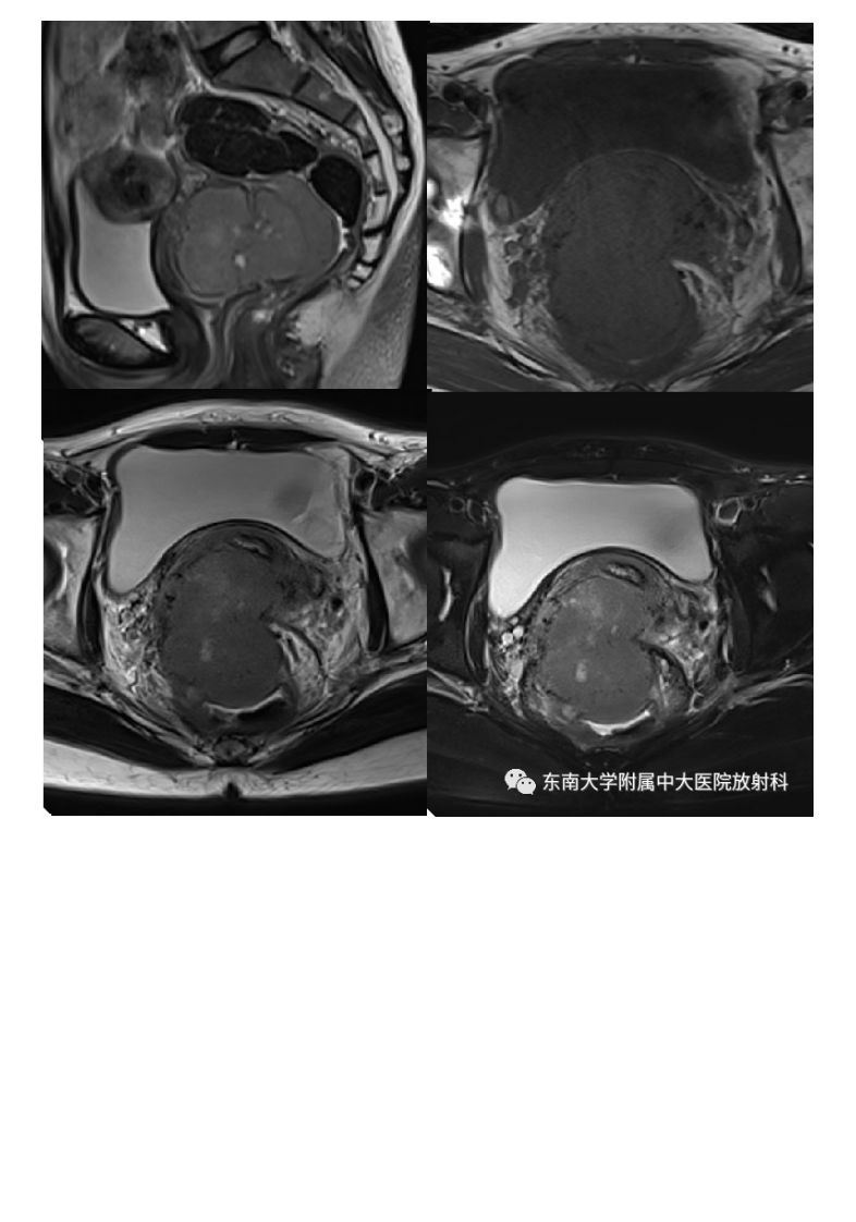 20210525_2【晨读结果公布】2021.05.24生殖系统疾病——病例1病理倾向于炎性假瘤；病例2：子宫内膜样癌；病例3：宫颈富细胞性肌瘤.pdf 第5页