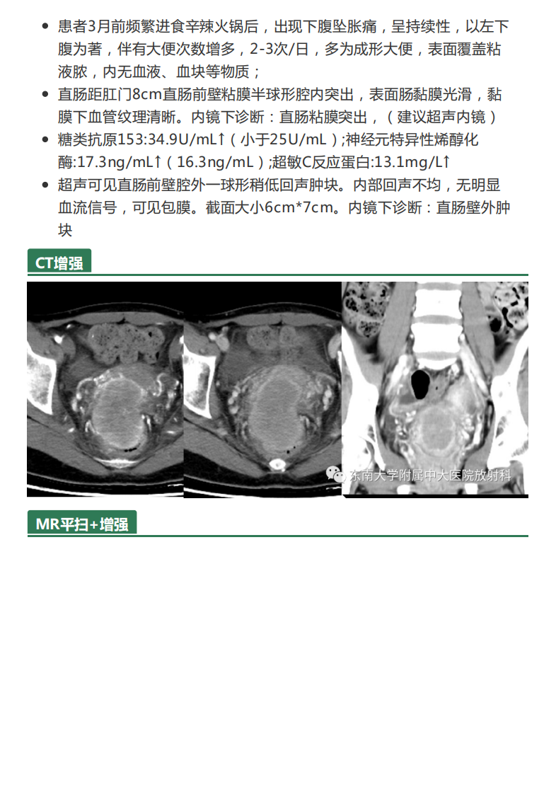 20210525_2【晨读结果公布】2021.05.24生殖系统疾病——病例1病理倾向于炎性假瘤；病例2：子宫内膜样癌；病例3：宫颈富细胞性肌瘤.pdf 第4页