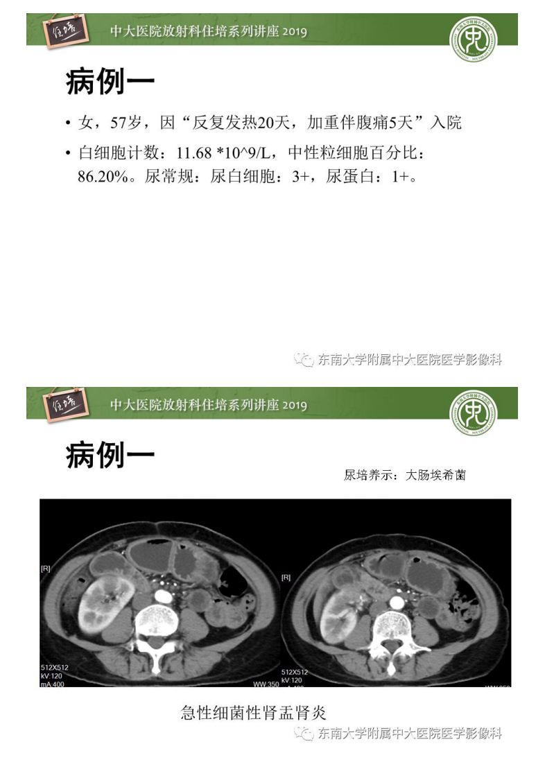 20190811_1【中大放射住培系列讲座第73期】肾脏感染性病变的影像学表现.pdf 第4页
