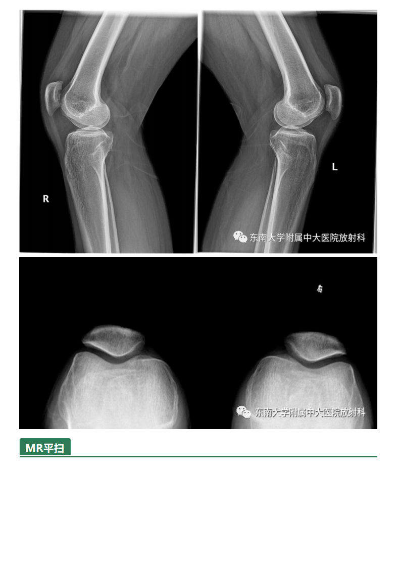 20210506_3【晨读结果公布】2021.05.06肌骨系统疾病&mdash;&mdash;髌骨软化症.pdf 第3页