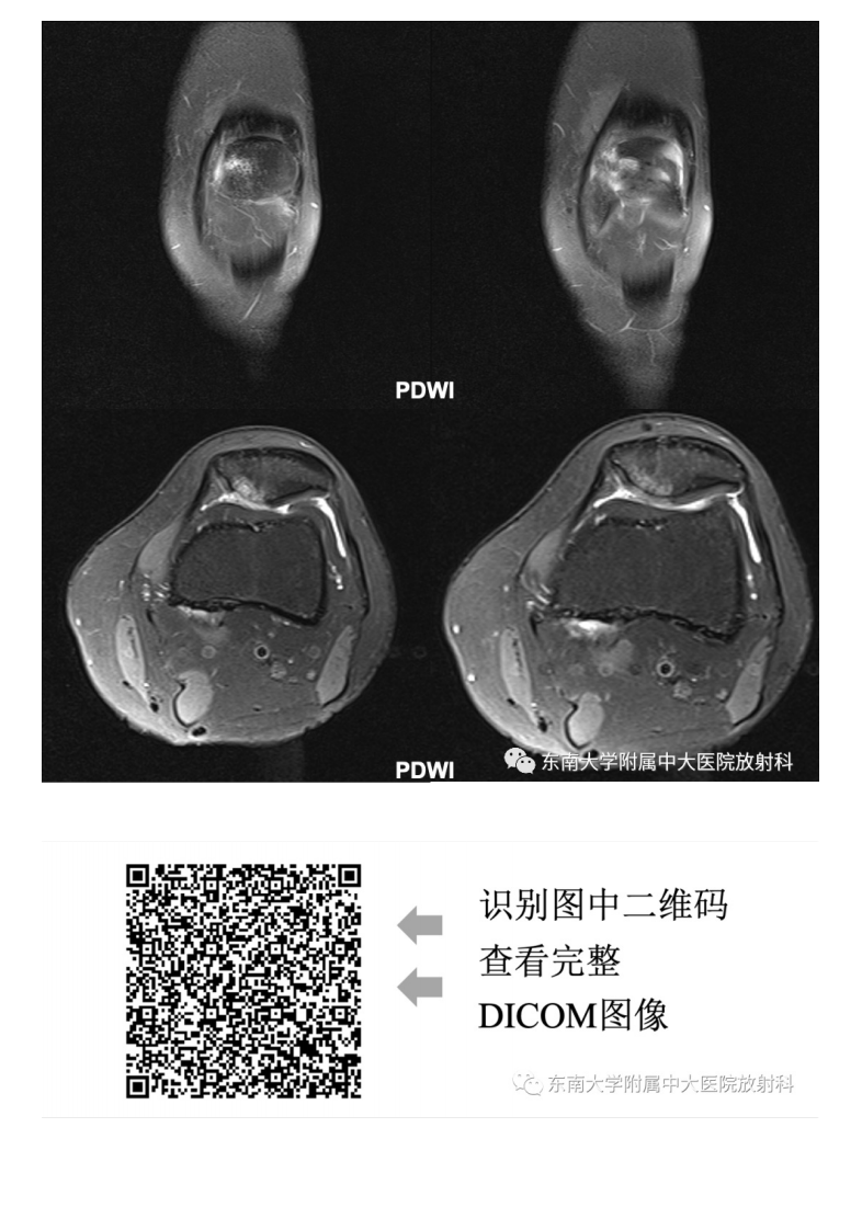 20210506_3【晨读结果公布】2021.05.06肌骨系统疾病&mdash;&mdash;髌骨软化症.pdf 第5页