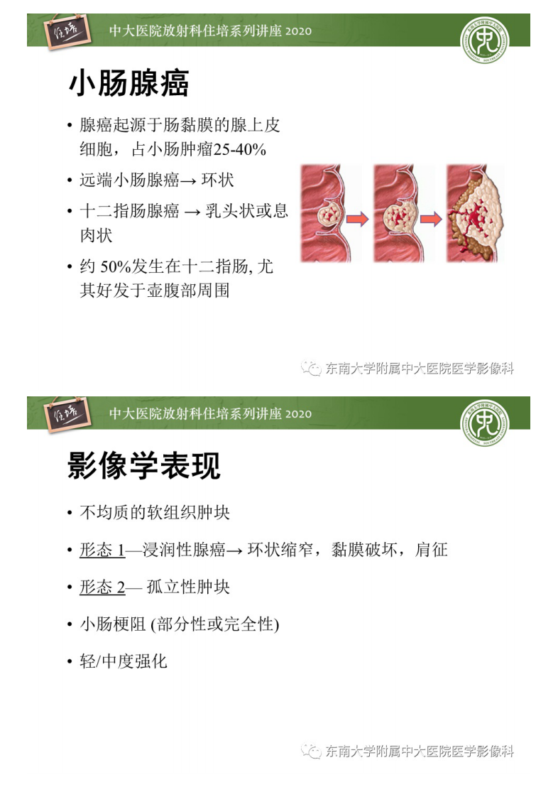 20200627_1【中大放射住培系列讲座】小肠恶性肿瘤的影像诊断思路.pdf 第5页