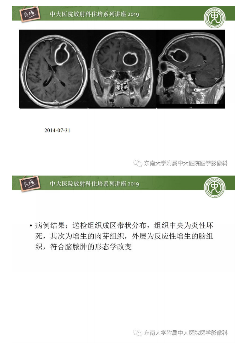 20190415_1【中大放射住培系列讲座第57期】脑脓肿的诊断与鉴别.pdf 第3页