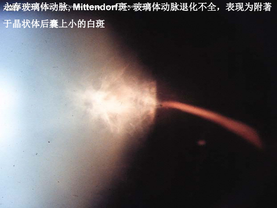 11)玻璃体疾病.ppt 第5页