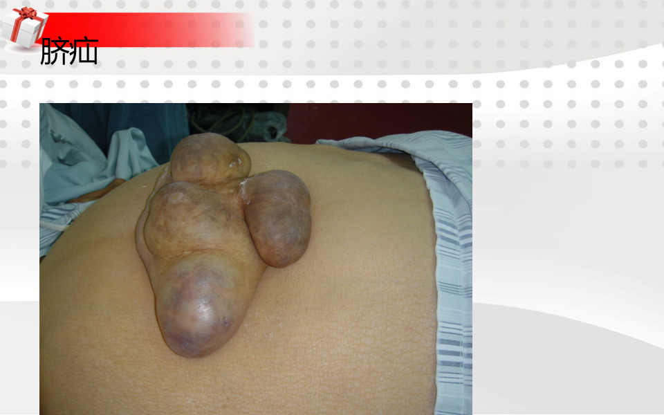 3)腹外疝-五年制课程.ppt 第3页