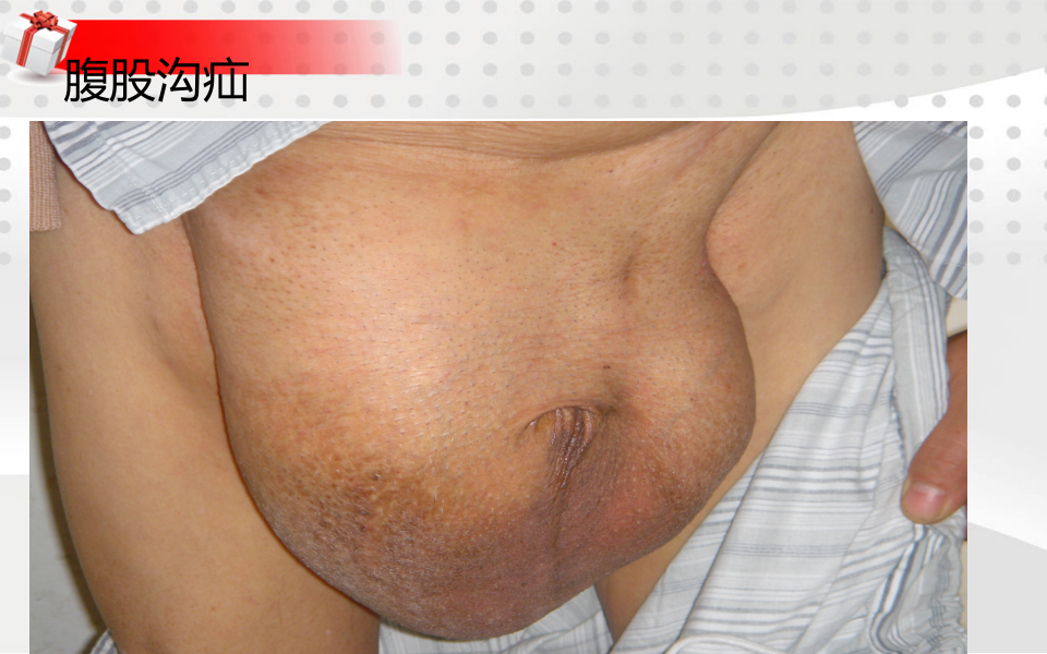 3)腹外疝-五年制课程.ppt 第2页