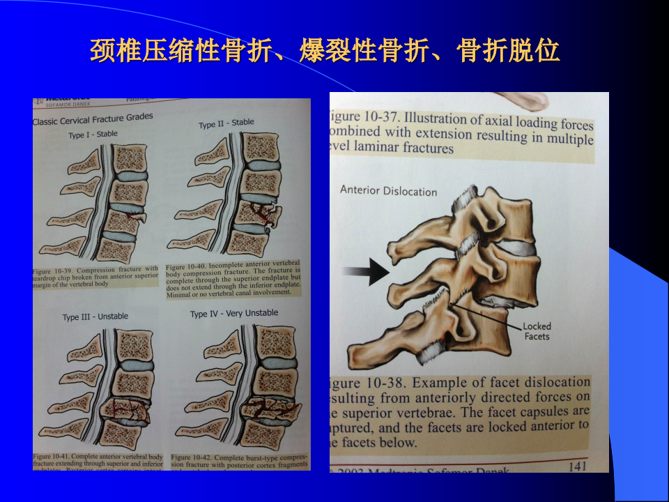 20)脊柱骨折1.ppt 第5页