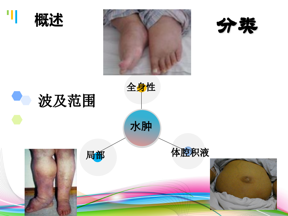 水肿（2014，5年）.ppt 第4页