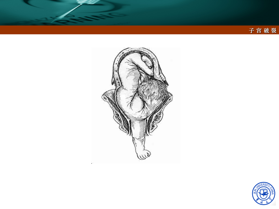 15)2015春放射子宫破裂.ppt 第5页