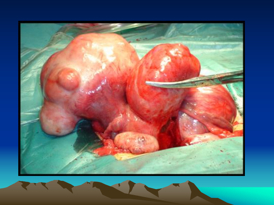 17)5子宫肌瘤，子宫内膜癌.ppt 第1页