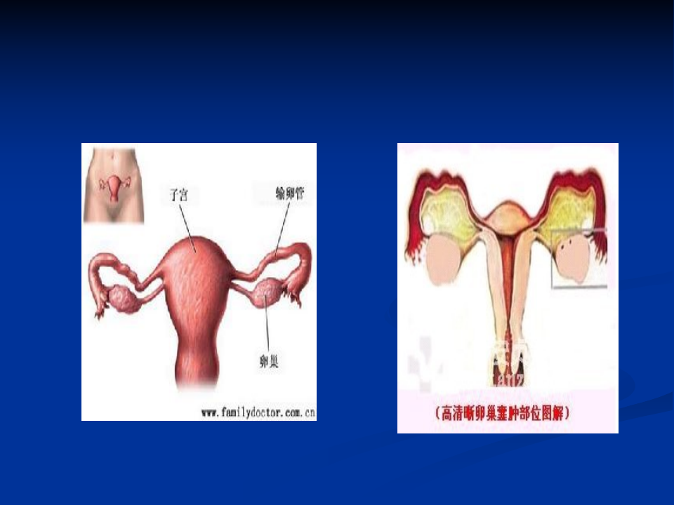 卵巢肿瘤-中日联谊医医院.ppt 第5页