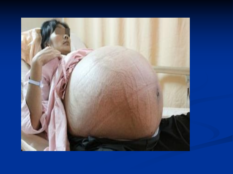 卵巢肿瘤-中日联谊医医院.ppt 第1页