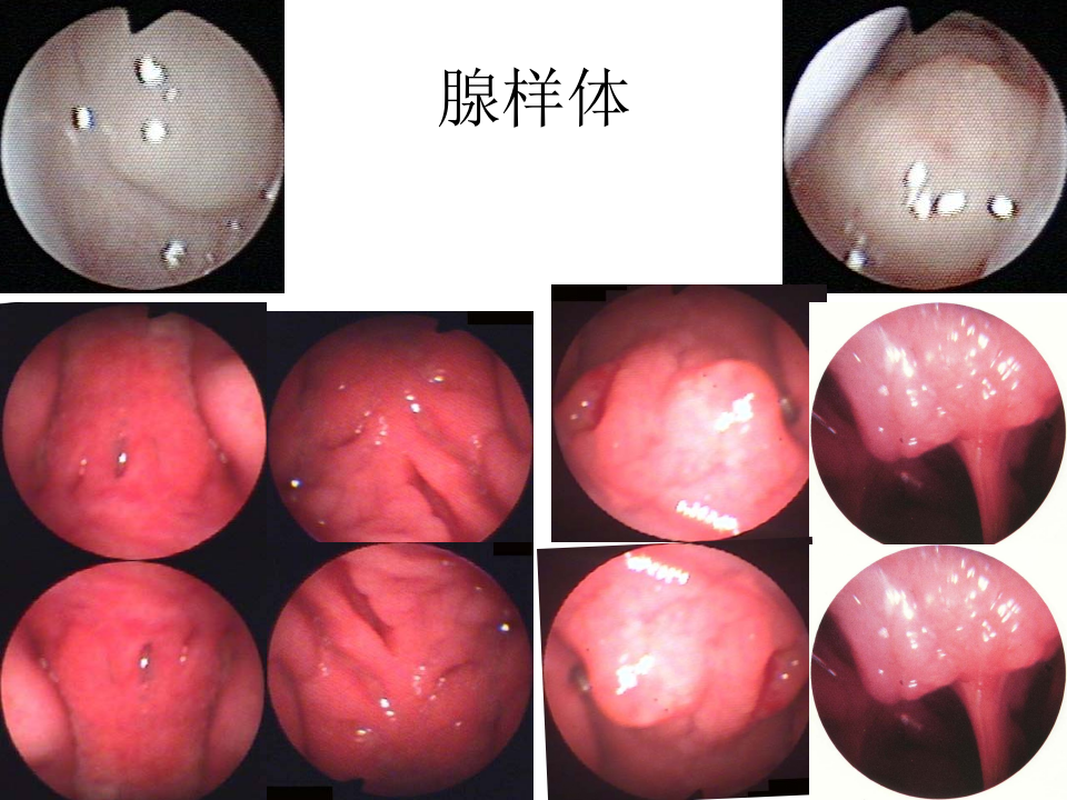 5)咽部解剖、扁桃体炎2015.ppt 第5页