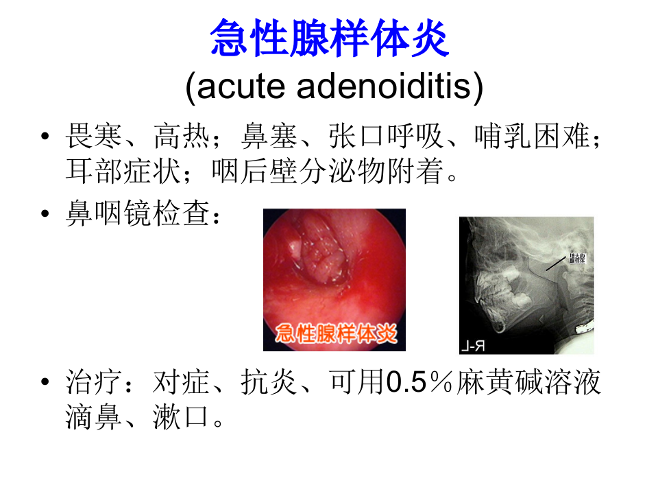 6)腺样体炎、咽及颌面脓肿、喉解剖、急慢性喉炎、声带息肉、急性会厌炎 .ppt 第4页